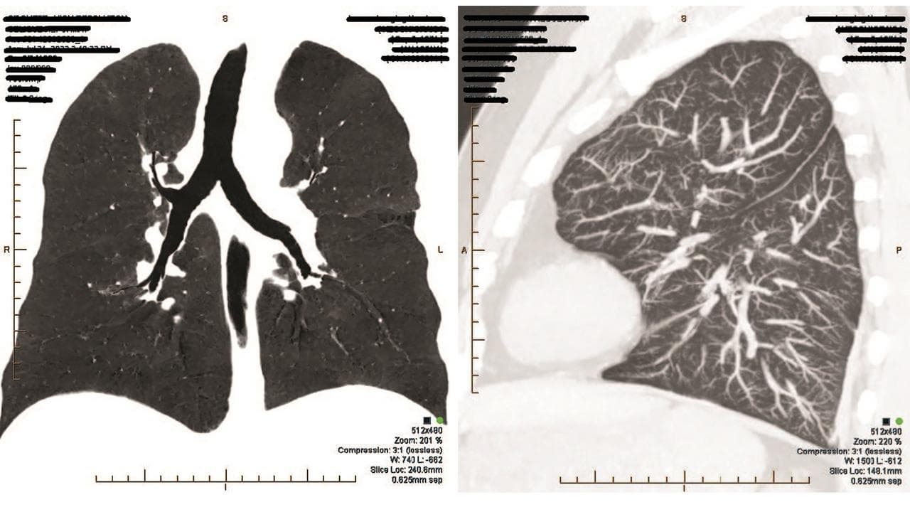 Two lungs scans from former coal miner Craig Keogh