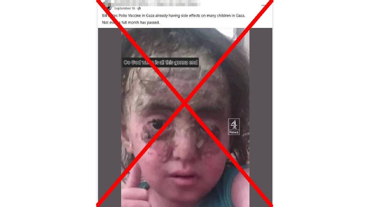 A post falsely claiming to show side effects of polio vaccination. 
