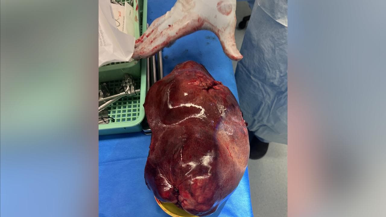 A massive tumour weighing nearly 2kg