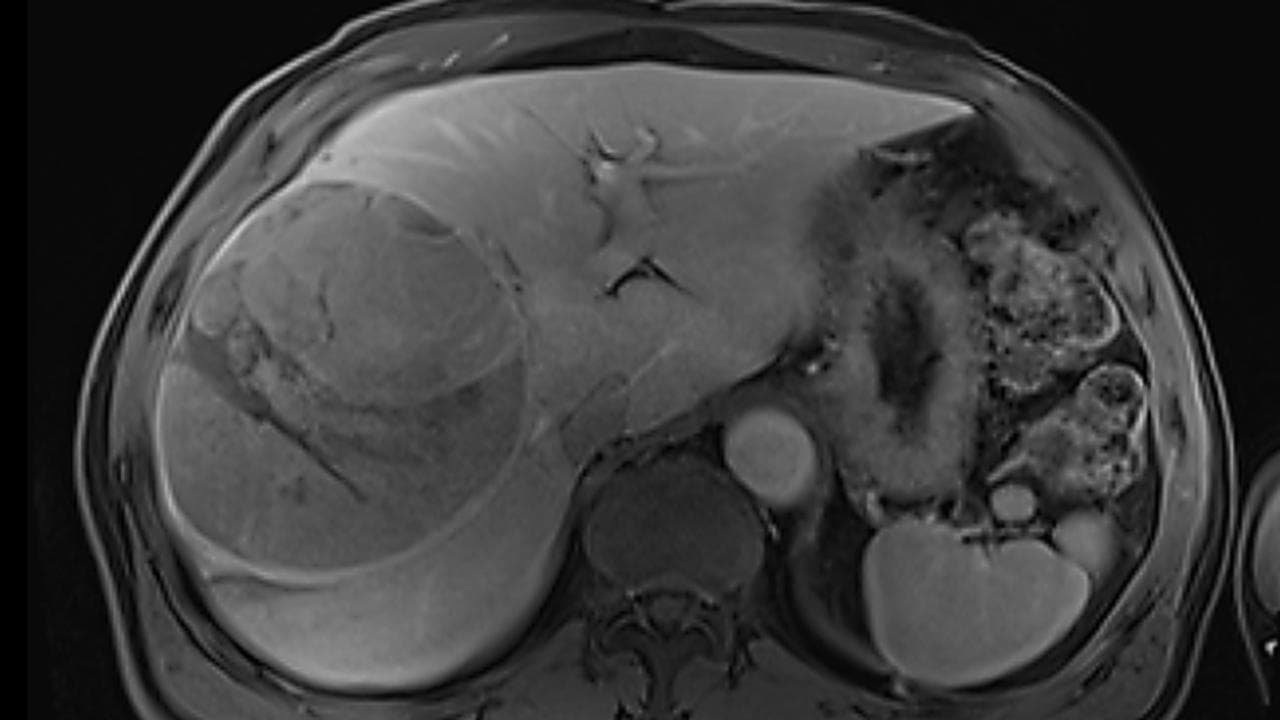 An MRI scan of rare tumour in Barrie