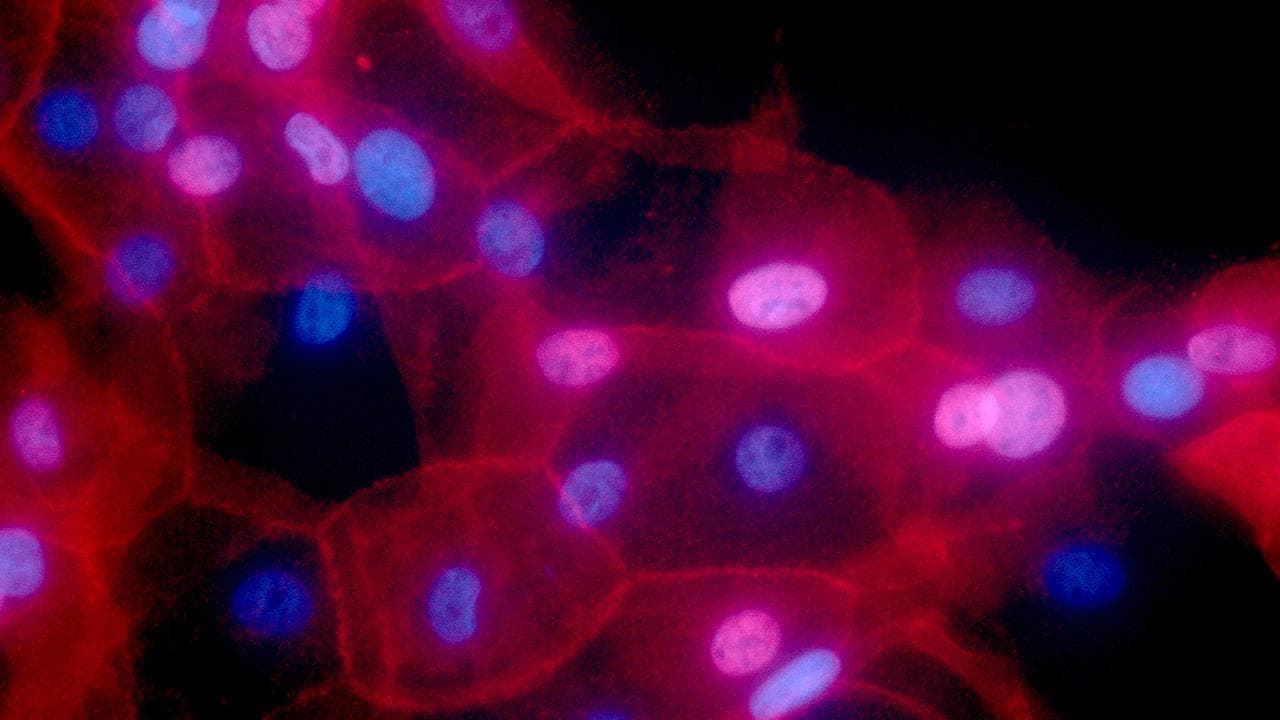 Microscopic view of cancer cells.