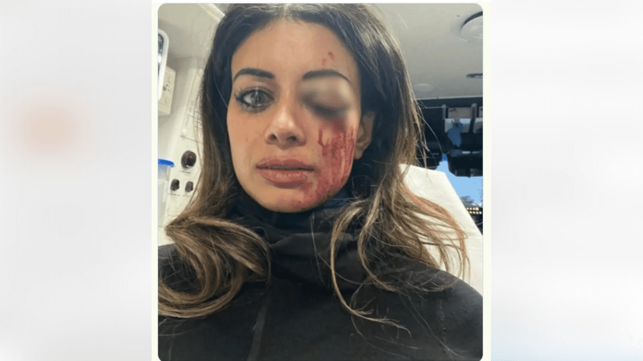 The flipped selfie image showing Ms Thomas's eye injury.