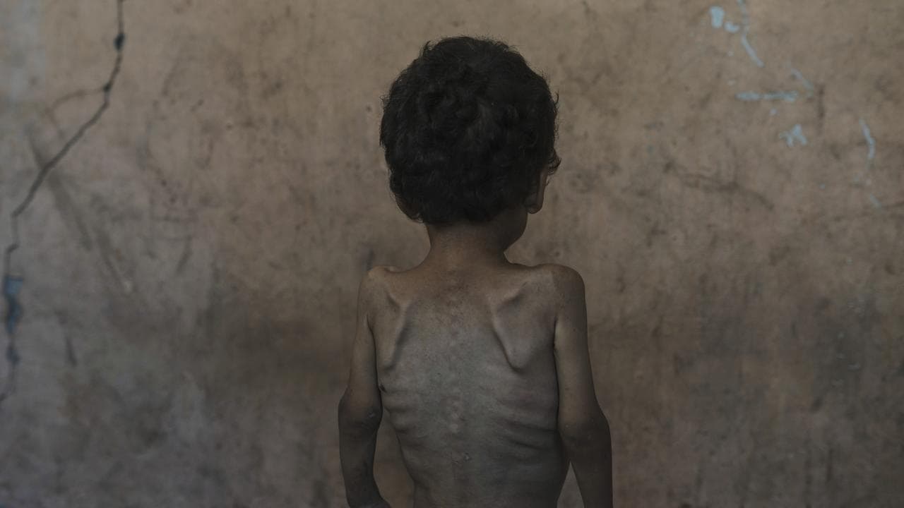 Emaciated Gazan child Yazan Abu Ful