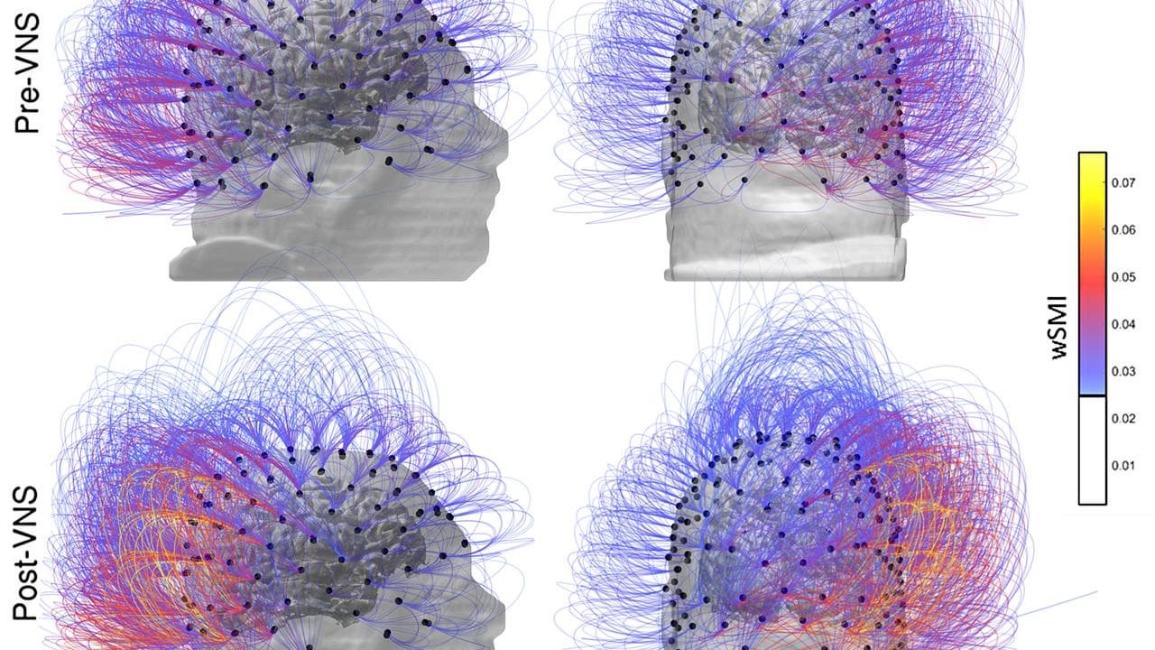 Vagus Nerve Stimulation diagram