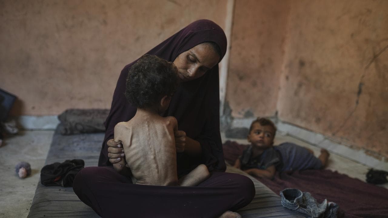 Naima Abu Ful poses with her 2-year-old malnourished child, Yazan
