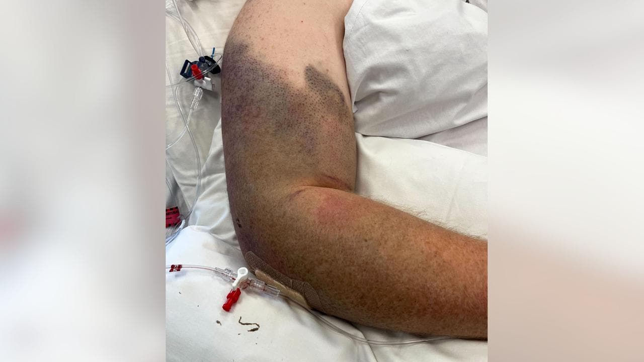 The bruised right arm of Luke Briggs (file image)
