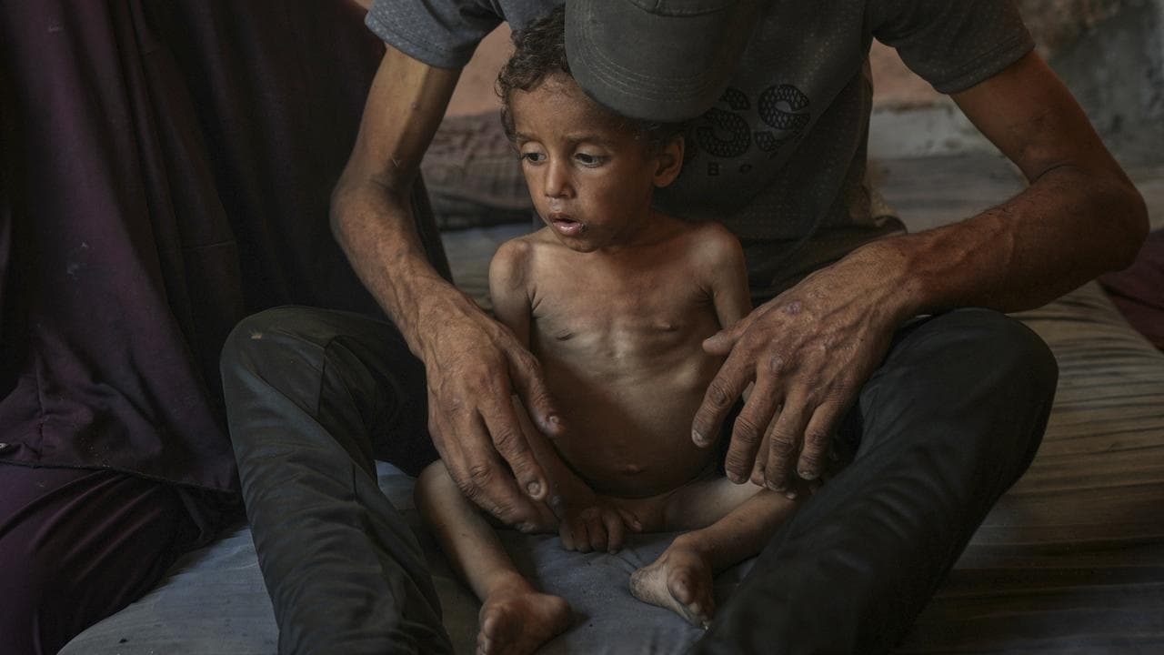 Yazan Abu Ful, a malnourished two-year-old in Gaza City.