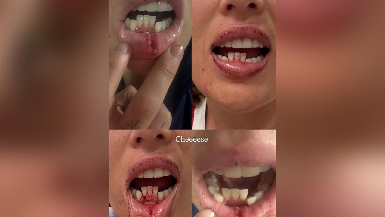 Isabelle Kelly's displaced teeth.