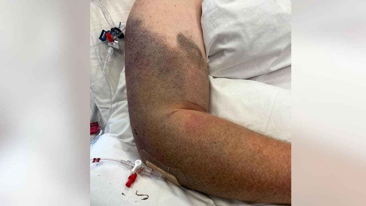 Bruising on Luke Briggs' arm (file)