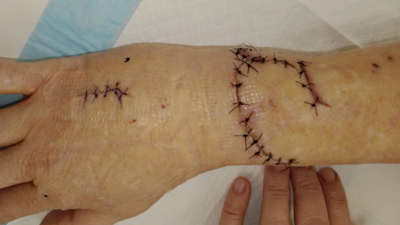 Emma Larnach's injuries after she was stabbed