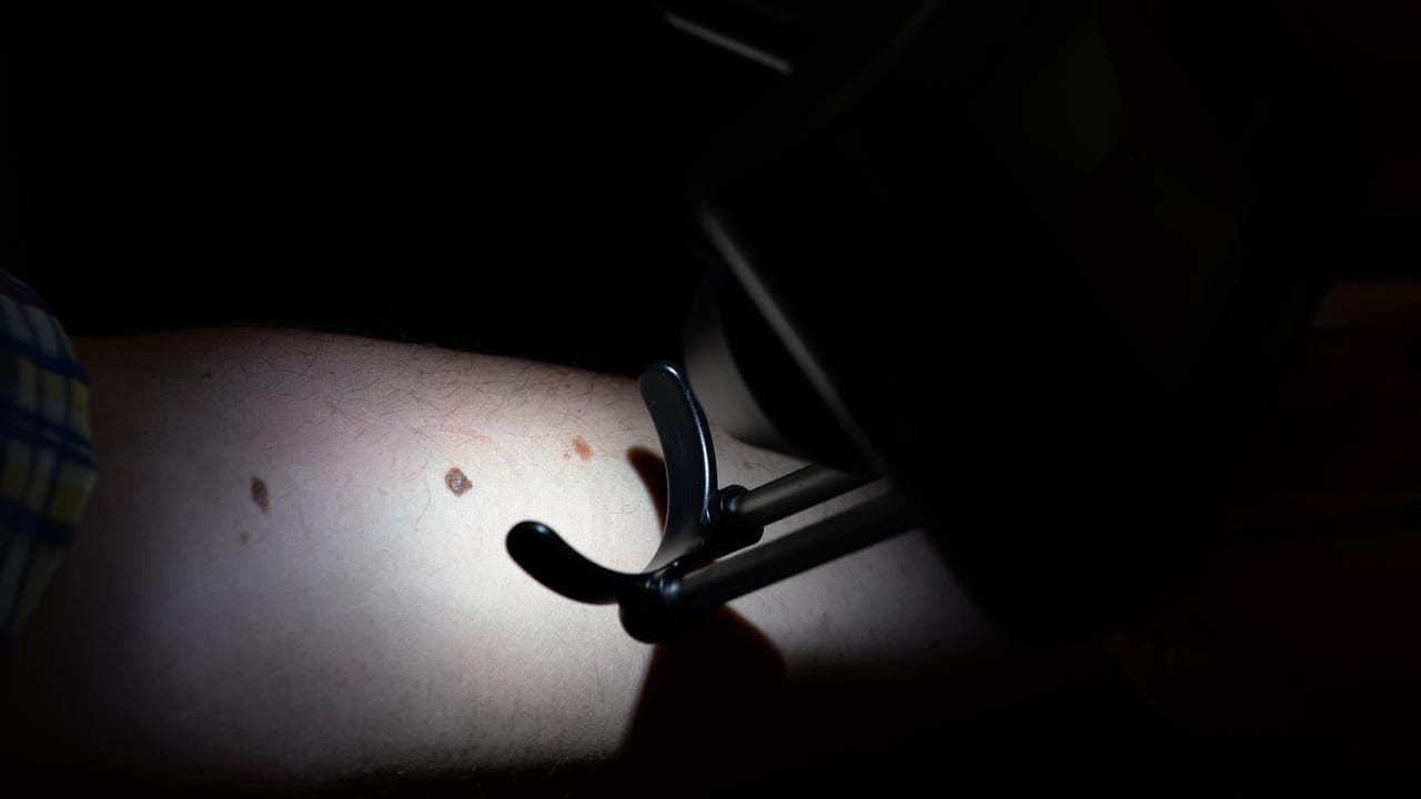 A patient being checked for skin cancers at a skin cancer clinic.