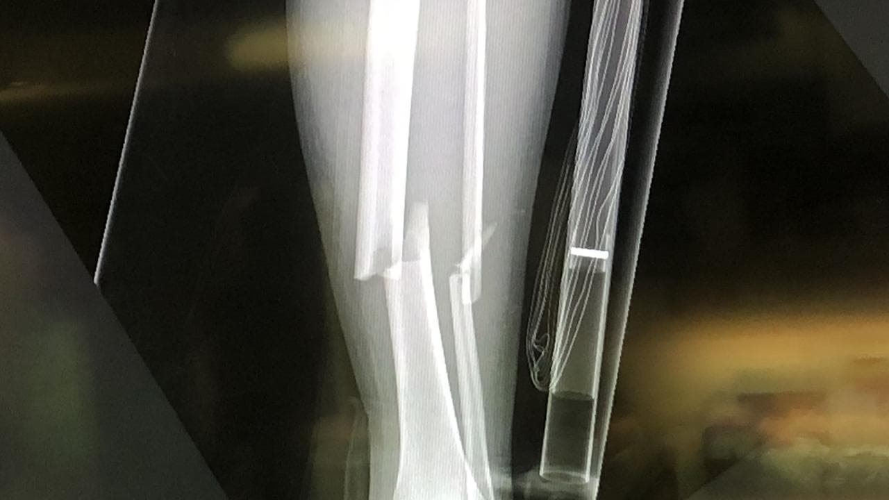 Farmhand Patrick Blomfield's leg x-ray