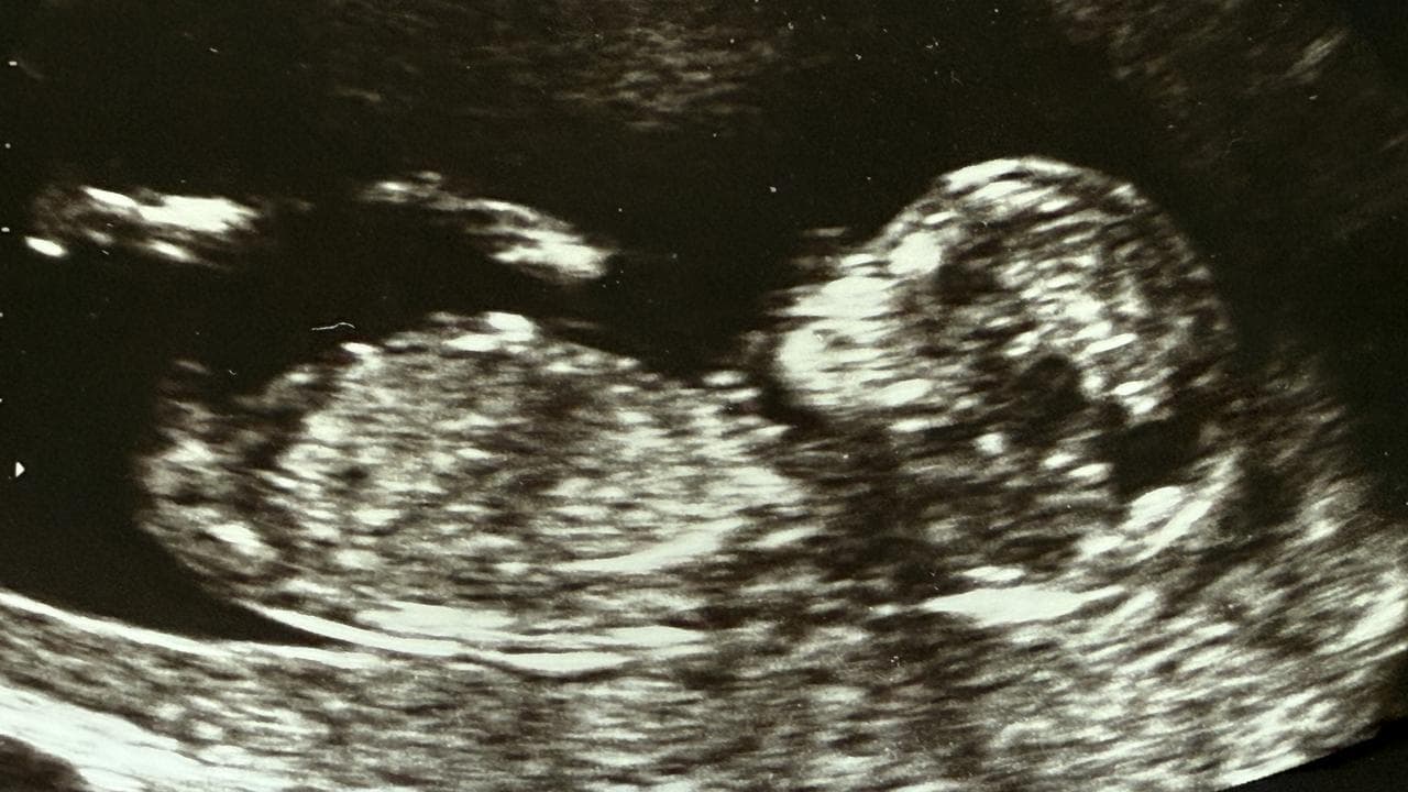 Ultrasound biometry of human fetus.