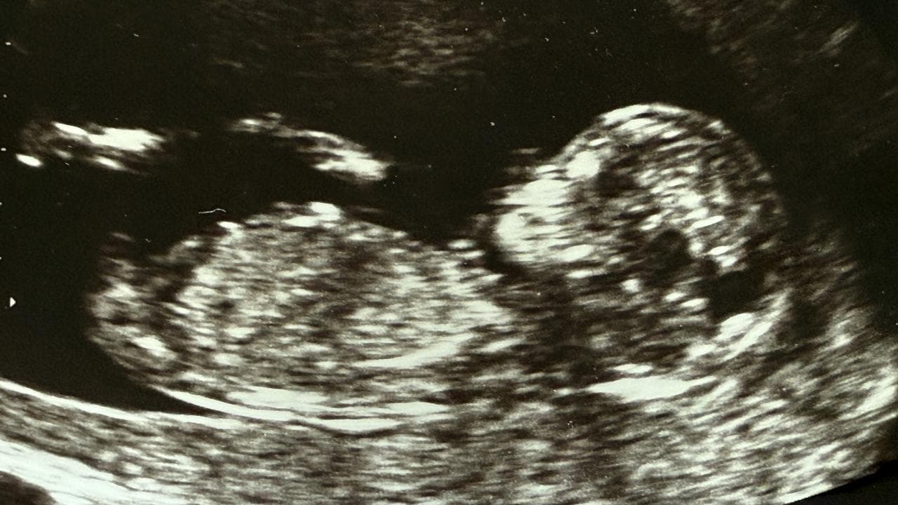 Ultrasound biometry of human fetus