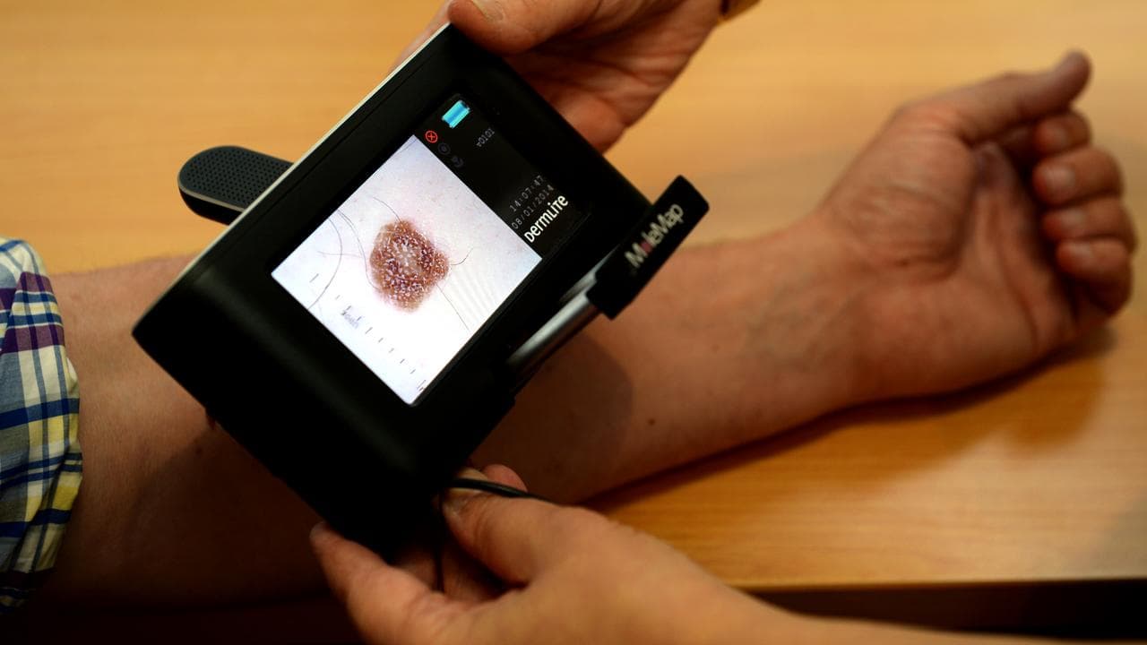 Melanoma cancer