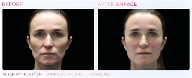 BTL's EMFACE Surpasses 1 Million Treatments, Becoming the Fastest-Growing Non-Invasive Facial Lifting Procedure