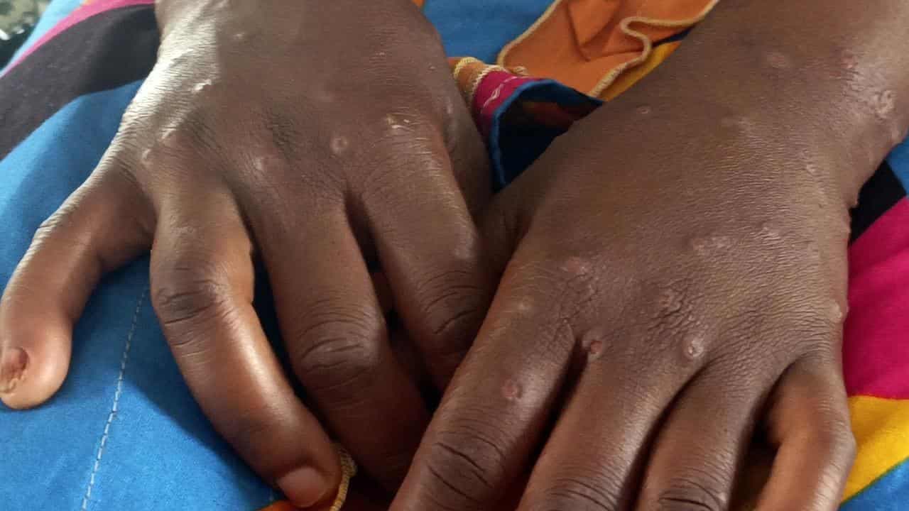 WHO has not 'admitted' mpox is COVID vaccine side effect