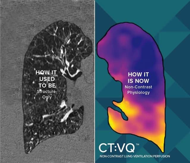 4DMedical's CT:VQ™ receives FDA 510(k) clearance; First-and-only CT-based VQ technology