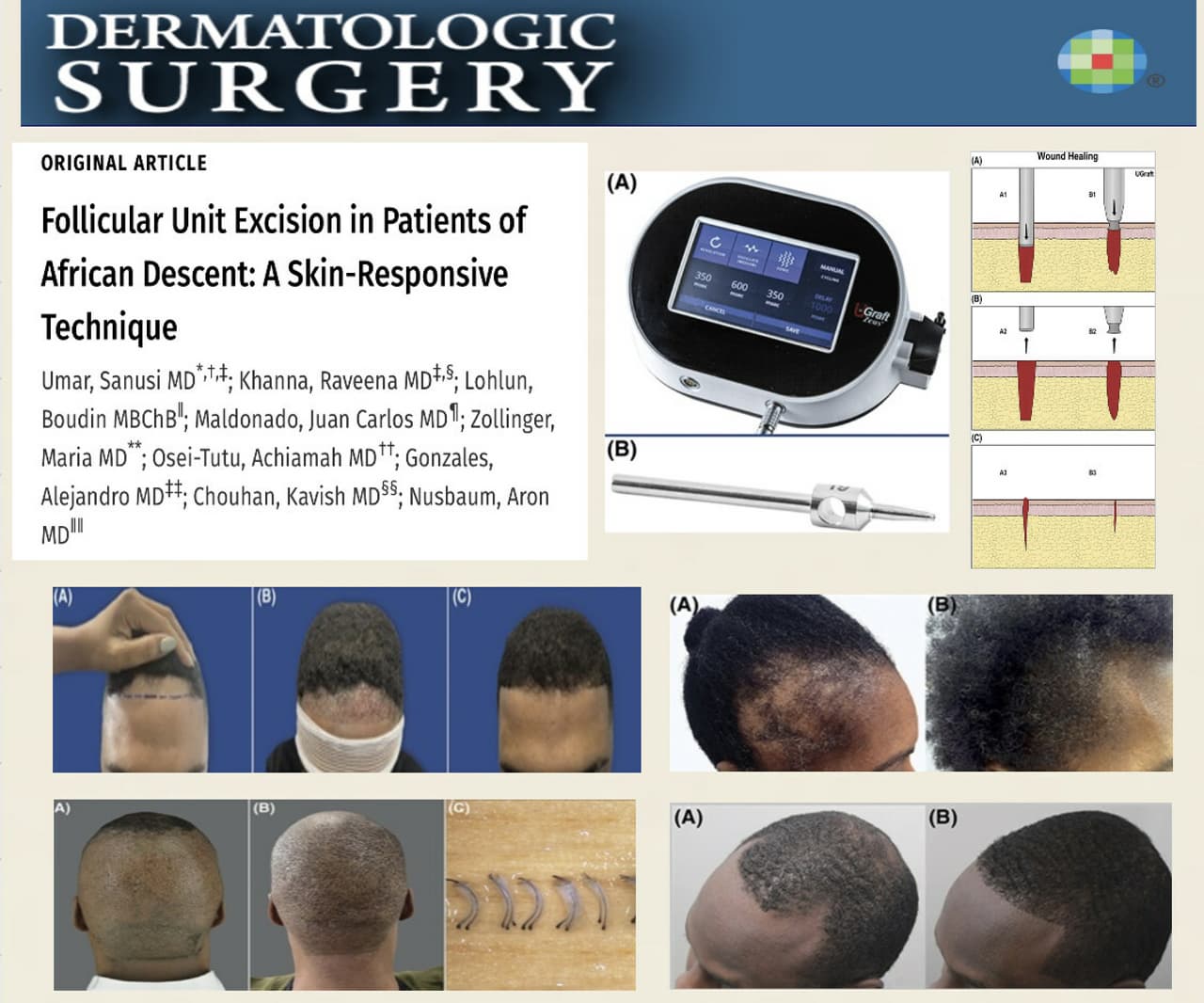 Revolutionary Technique Offers Hope for Hair Restoration in Individuals of African Descent