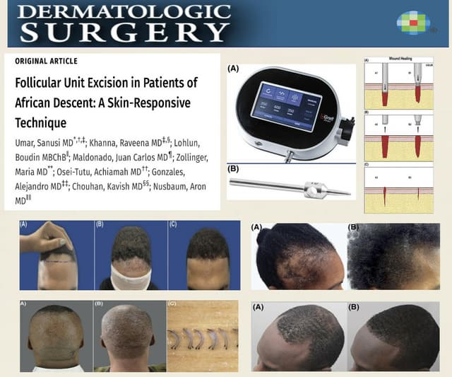Revolutionary Technique Offers Hope for Hair Restoration in Individuals of African Descent