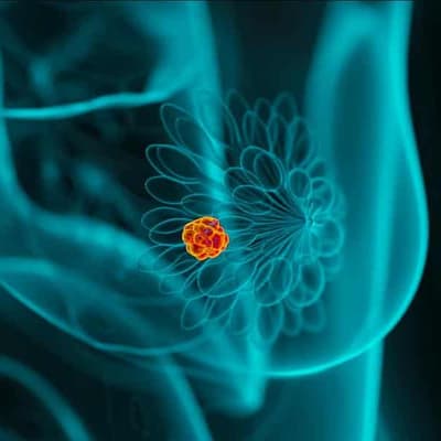 New hope for Aussies battling early stage breast cancer