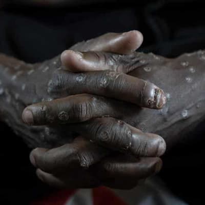 No, US government agency did not say there's no evidence of mpox