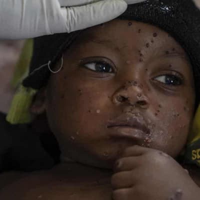 Claimed link between mpox and COVID vaccines is 'scientifically baseless'