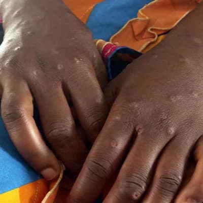 WHO has not 'admitted' mpox is COVID vaccine side effect