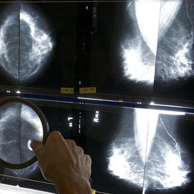 Hidden breast cancer costs increase burden of disease