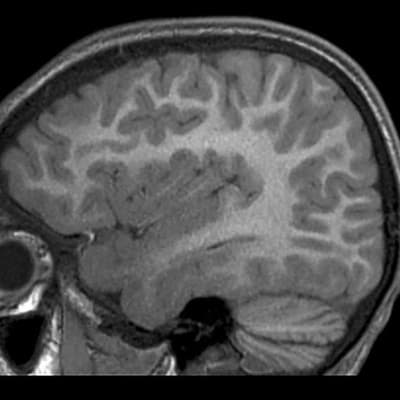 Aussie imaging agent to help brain cancer patients