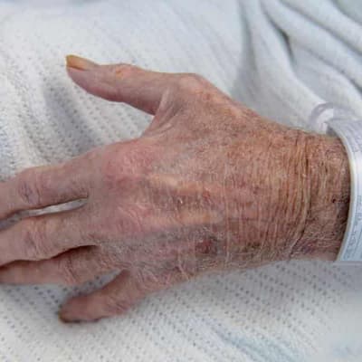 Arthritis cure hope as 'Gremlin' therapy shows promise